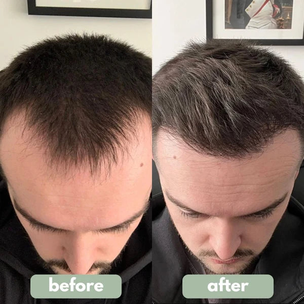 Advanced Hair Growth Roll-on Serum