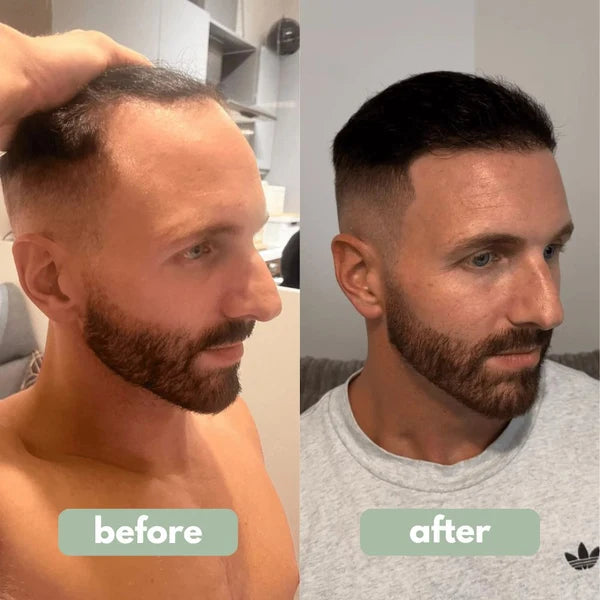 Advanced Hair Growth Roll-on Serum